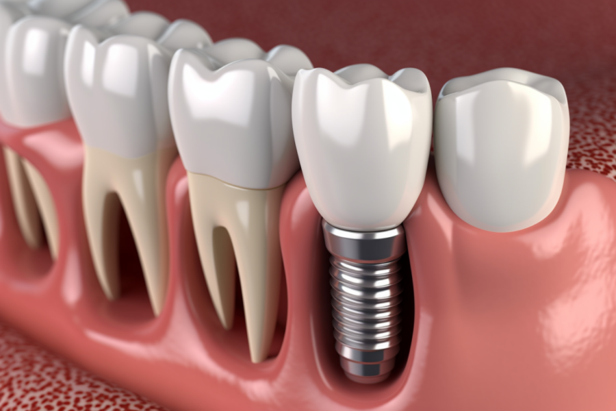 Illustration of 3 normal teeth and one dental implant